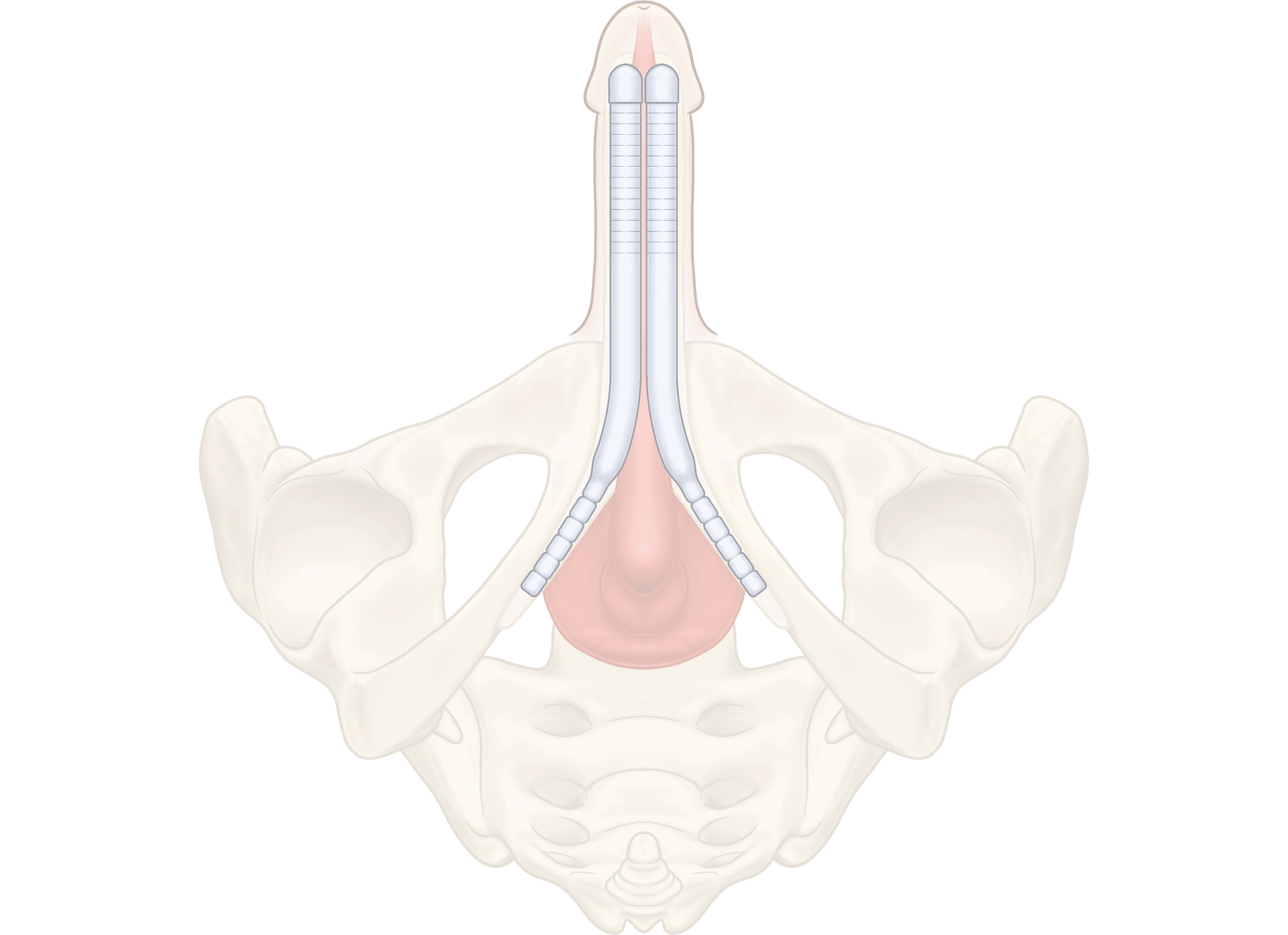 ZSI 100 CF Malleable Penile Implant (Soft)