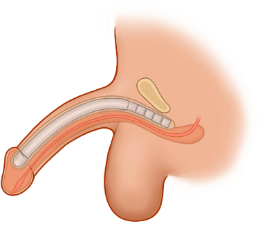 ZSI 100 CF Malleable Penile Implant (Soft)