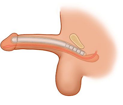 ZSI 100 CF Malleable Penile Implant (Soft)