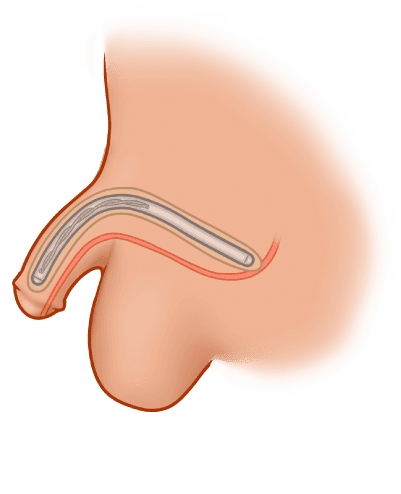 ZSI 100 D4 Malleable Implant for Metoidioplasty