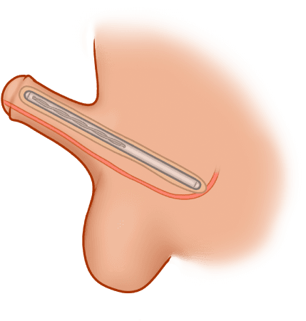 ZSI 100 D4 Malleable Implant for Metoidioplasty