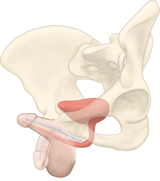 ZSI 100 D4 Malleable Implant for Metoidioplasty