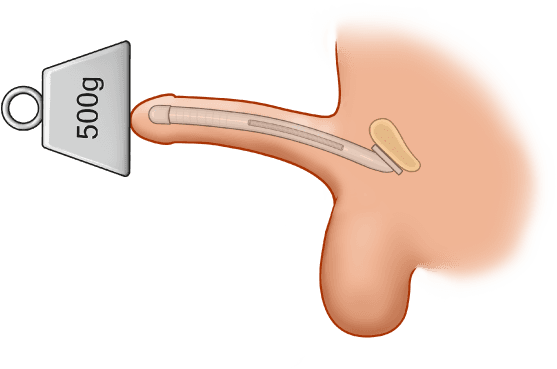 ZSI 100 FTM Malleable Implant for Neopenis