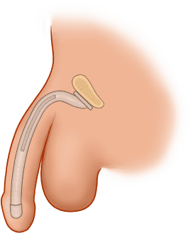 ZSI 100 FTM Malleable Implant for Neopenis