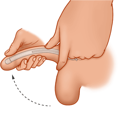 ZSI 100 FTM Malleable Implant for Neopenis