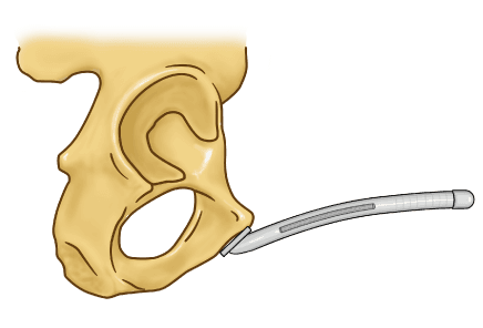 ZSI 100 FTM Malleable Implant for Neopenis