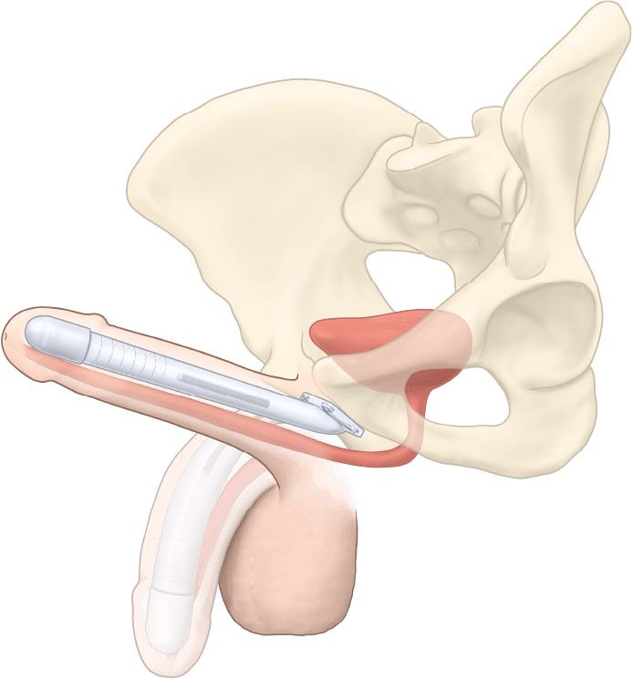 ZSI 100 FTM Malleable Implant for Neopenis
