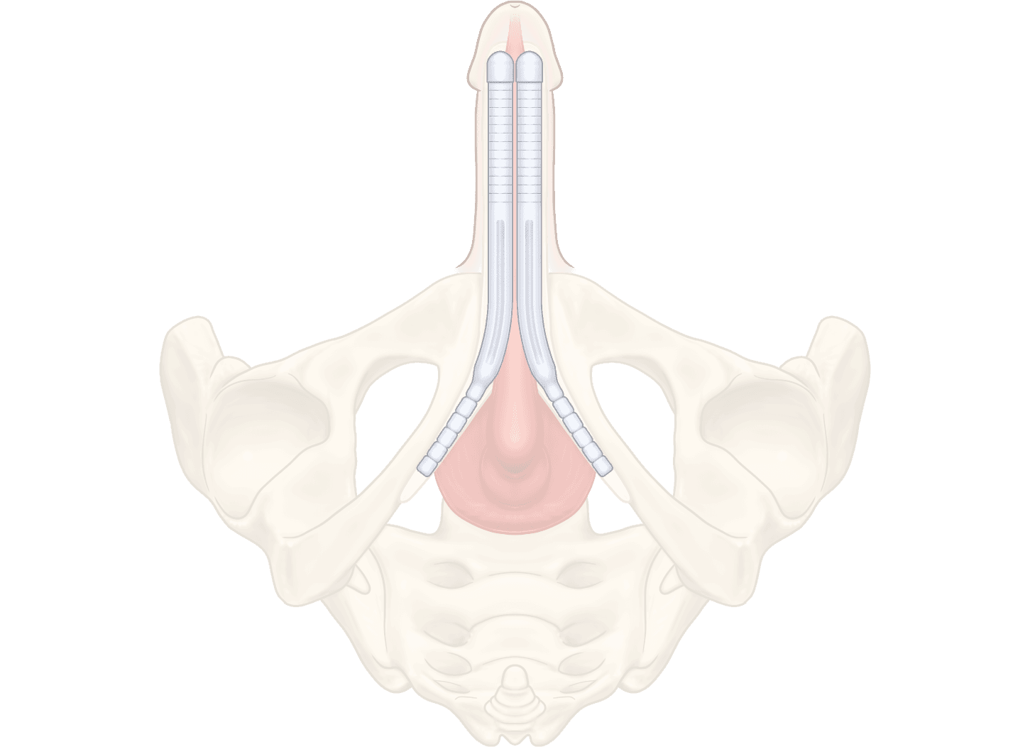 ZSI 100 Malleable Penile Implant