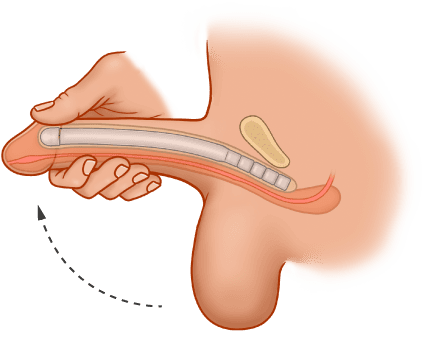 ZSI 100 Malleable Penile Implant