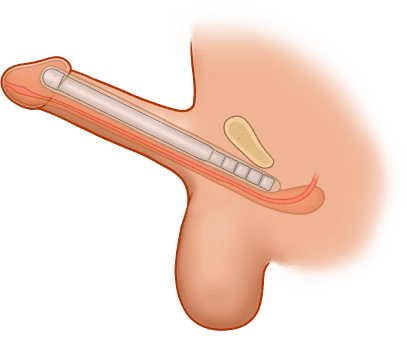ZSI 100 Malleable Penile Implant