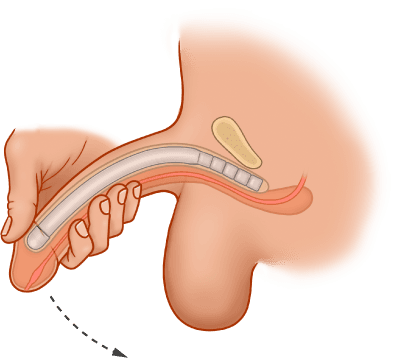 ZSI 100 Malleable Penile Implant