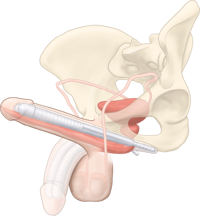 ZSI 100 Malleable Penile Implant