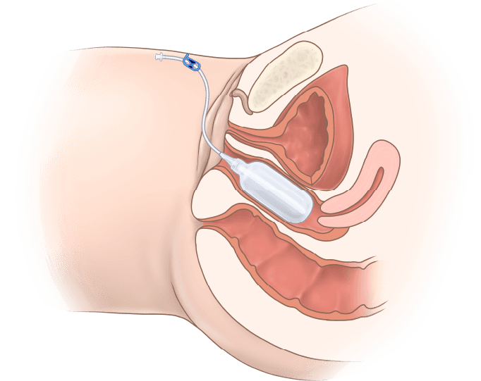 ZSI 200 NS Vaginal Expander (Cis Women)