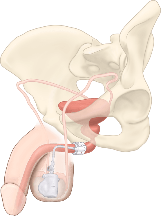 ZSI 375 PF Artificial Urinary Sphincter