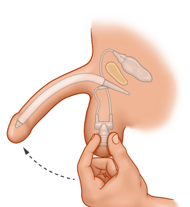 ZSI 475 FTM Inflatable Implant for Neopenis