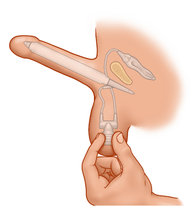 ZSI 475 FTM Inflatable Implant for Neopenis