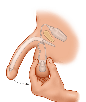 ZSI 475 FTM Inflatable Implant for Neopenis