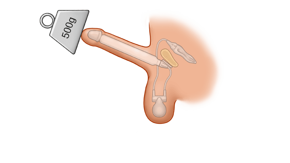 ZSI 475 FTM Inflatable Implant for Neopenis