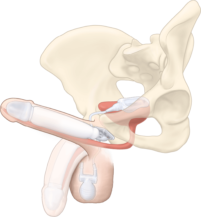 ZSI 475 FTM Inflatable Implant for Neopenis