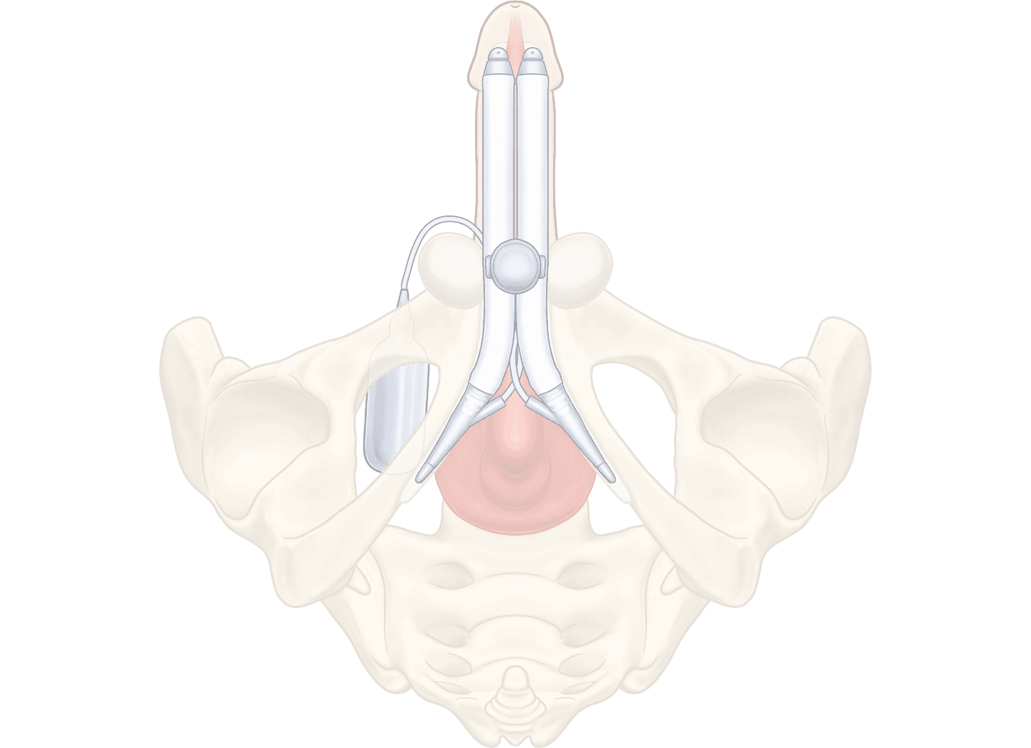 ZSI 475 Inflatable Penile Implant