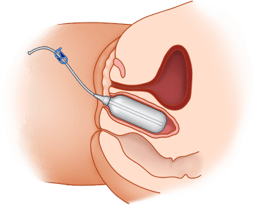 ZSI 200 NS Vaginal Expander (Trans Women)